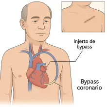 versión ilustrativa y didáctica del Bypass coronario