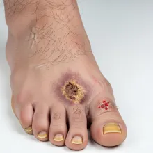 Imagen de referencia pie diabético