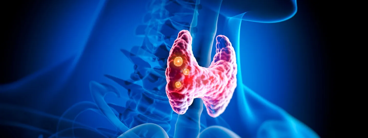 TIROSEC: Molecular, Clinical and Histopathological Profile of Papillary Thyroid Carcinoma in a Colombian Cohort