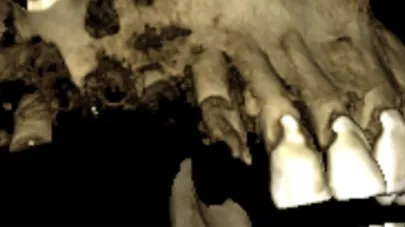 Osteonecrosis Maxilar