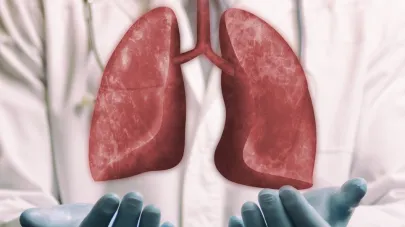 Trasplante Pulmonar en Colombia