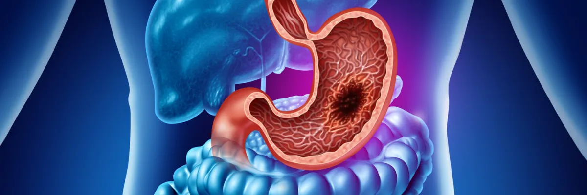 Tumores Digestivos