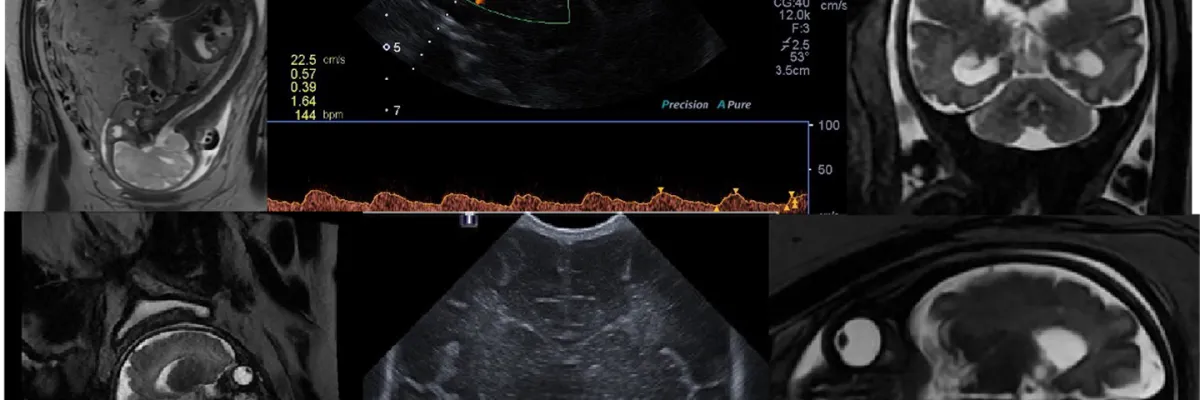 Simposio de Neurorradiologia