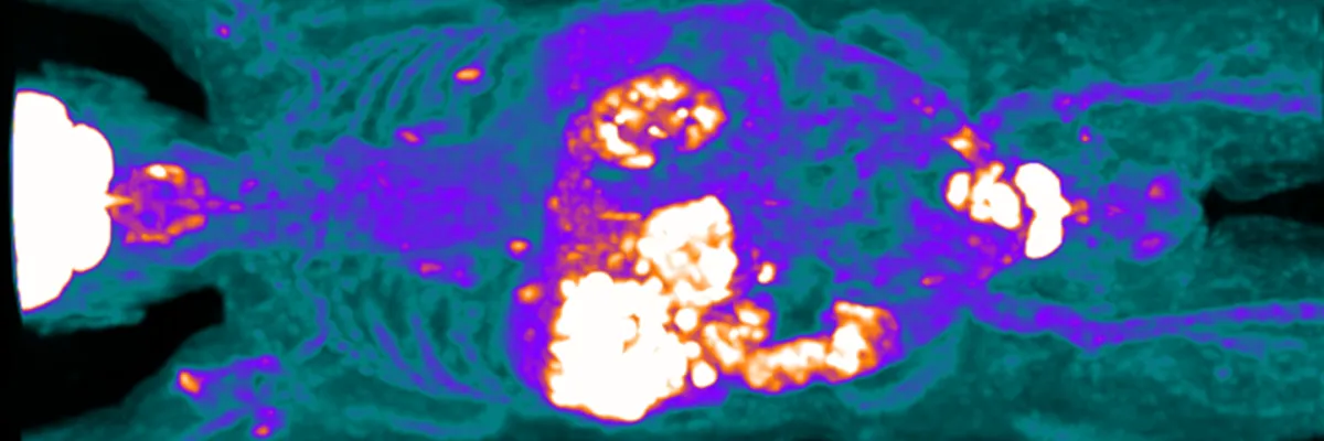 Simposio Teragnostico en Hepatocarcinoma
