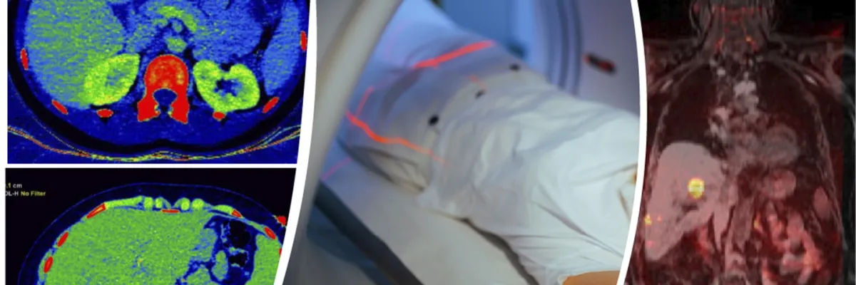 Imagenes Avanzadas Oncologia Abdominal