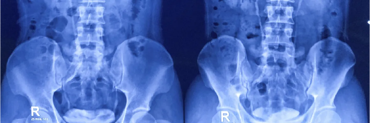 Uroncologia Cancer de Prostata
