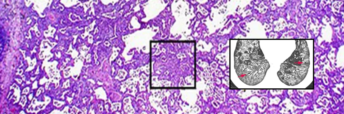 Enfermedad Pulmonar Intersticial