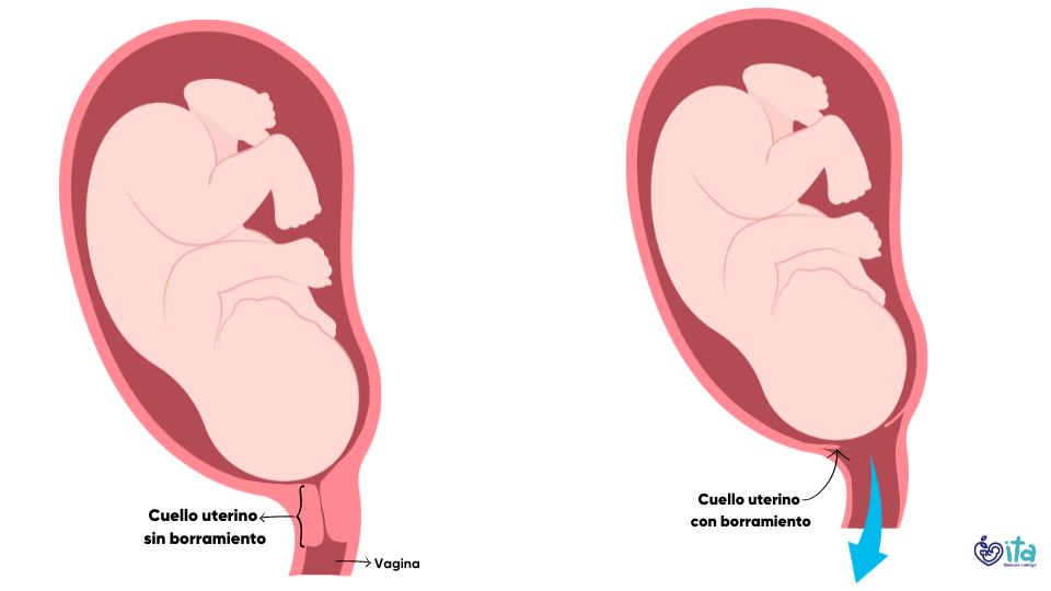 Borramiento del cuello uterino