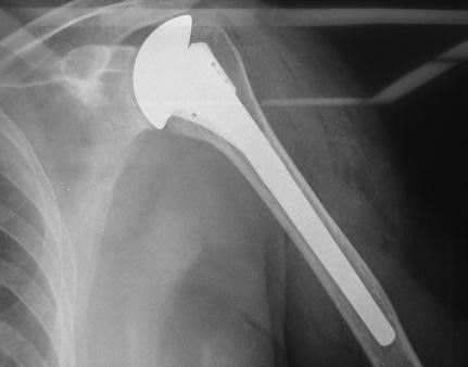 HEMIARTPLASTIA GLENO HUMERAL-64 AÑOS-ROSALBA CALDAS 006