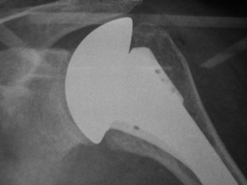 HEMIARTPLASTIA GLENO HUMERAL-64 AÑOS-ROSALBA CALDAS 007