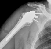 Reverse shoulder arthroplasty Rodriguez - 17