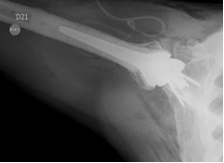 Reverse shoulder arthroplasty Rodriguez - 18