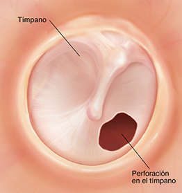 Perforación Tinpanica FSFB