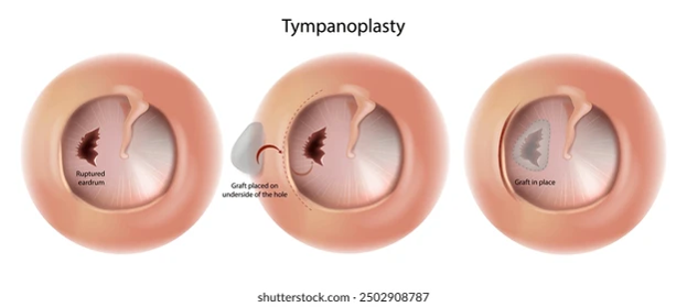 Timpanica fsfb