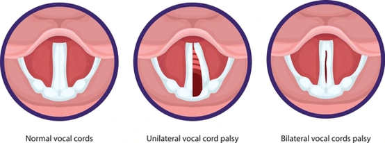Paralisis de cuerdas vocales FSFB