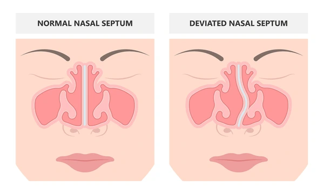 DESVIACIÓN TABIQUE NASAL FSFB