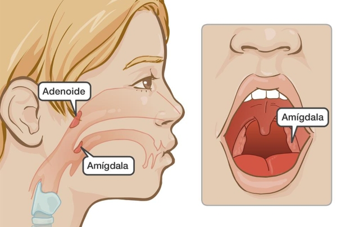 HIPERTROFIA DE AMÍGDALAS PALATINAS Y ADENOIDES