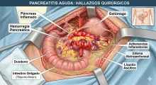 Pancreatitis